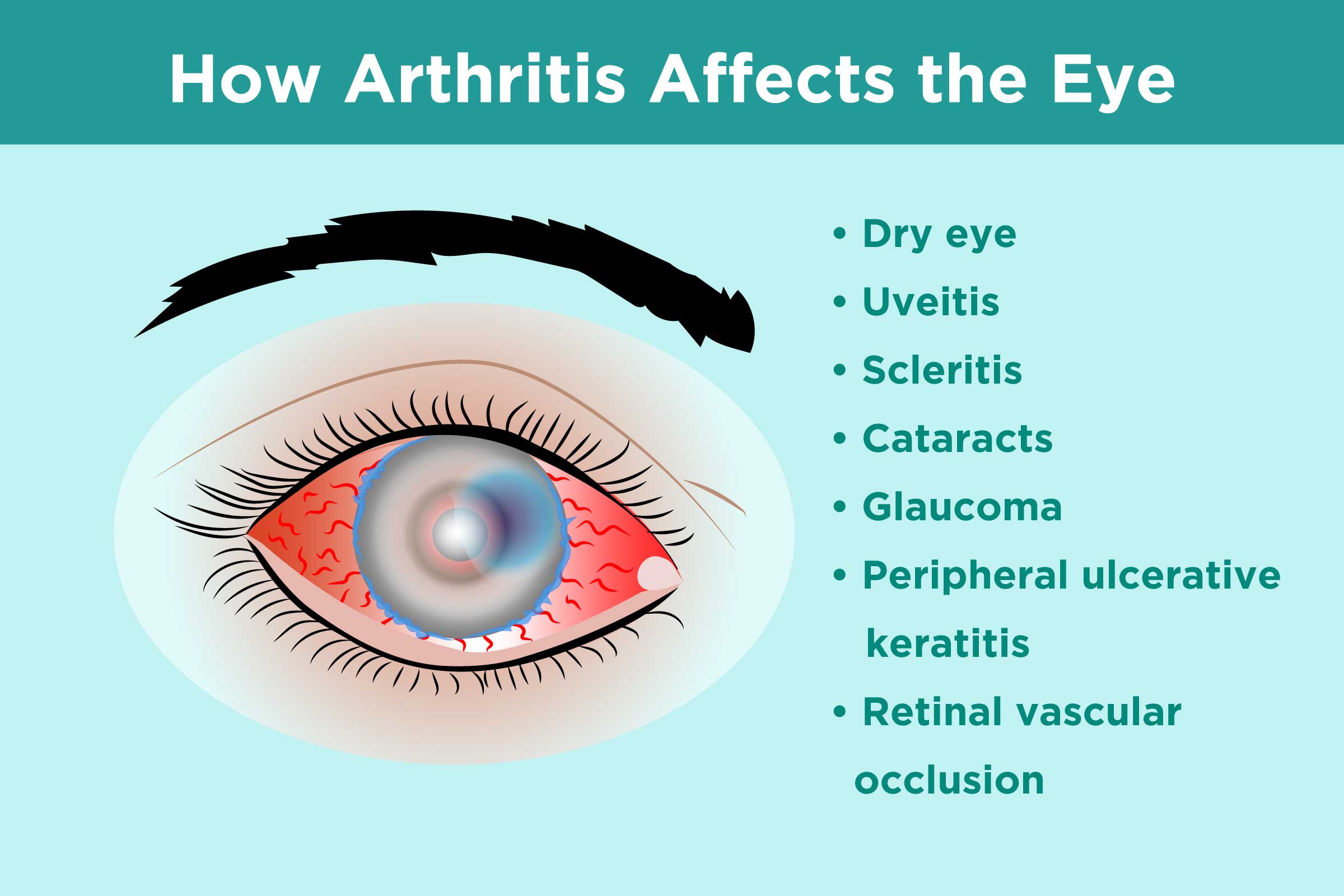 What Different Eye Conditions Look Like